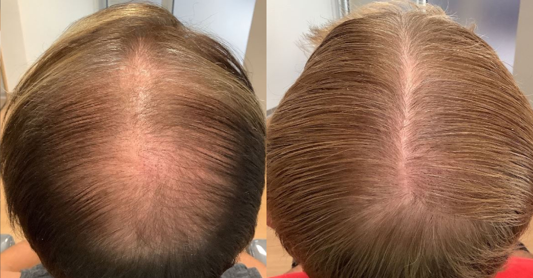 Before and after hair restoration treatment - Age 55 — After 5 Sessions