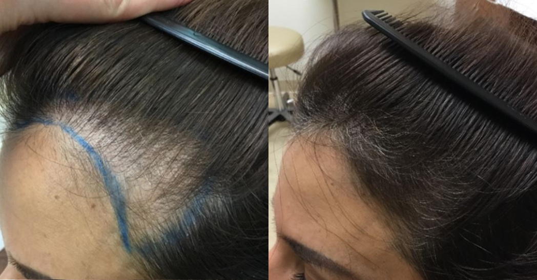 Before and after hair restoration treatment - Female, 38 — After 3 Sessions