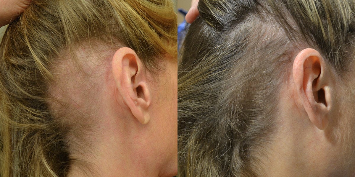 Before and after hair restoration treatment - Female, 42 — After 4 Sessions